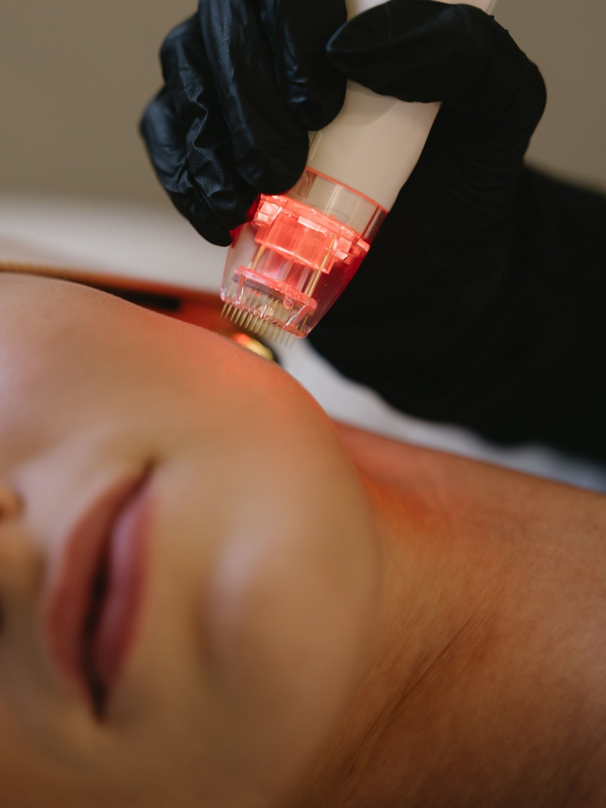 Close-up of the UltraVision RF microneedling tip treating the neck and jaw area